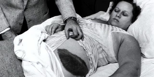 1954年，美国一女子在睡梦中，突然感觉腰部被什么东西蹭着了一样，疼痛难忍，等她