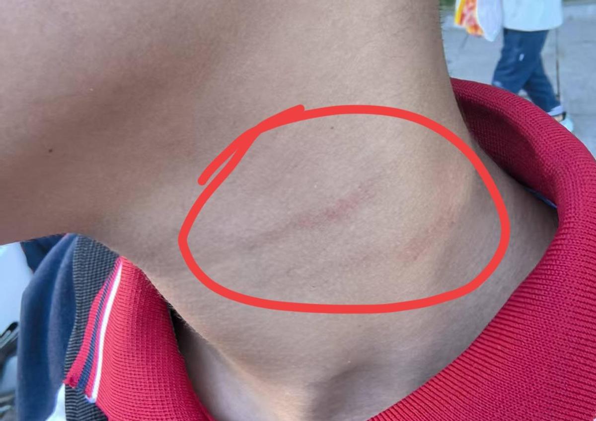 老师惩戒学生，一不小心就伤到孩子，这事儿真不是小事。
指甲太长，一划就破皮，谁也