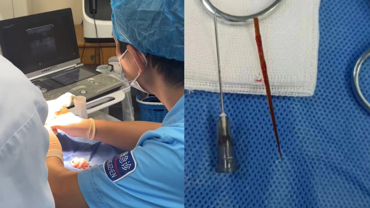 【女子睡竹席被竹刺扎屁股，医生找2小时才拔出，网友直呼太真实】7月20日，广西南