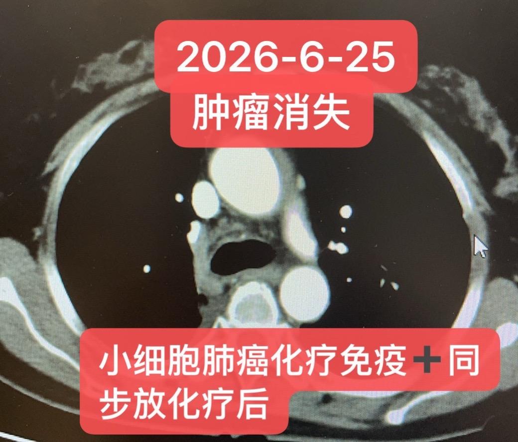 小细胞肺癌局部晚期治疗后：肿瘤消失。患者女，51岁（IIIA期，T1c...