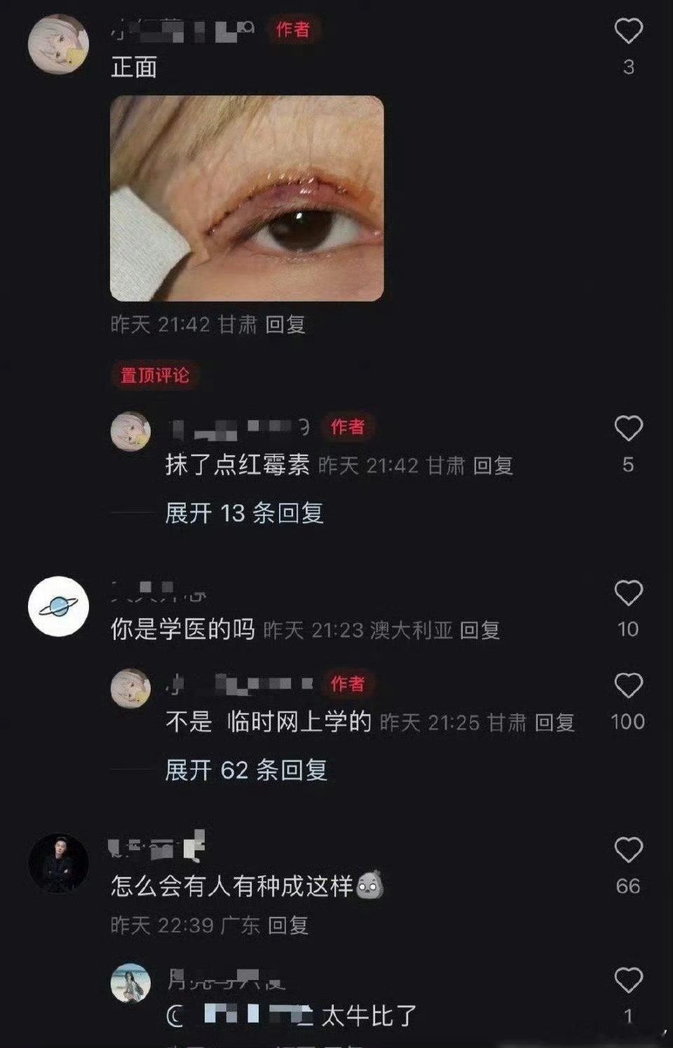 这个网友在网上自学割双眼皮。。。 人怎么可以有种成这样…… 
