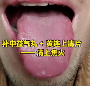 不到5 块钱通三焦！补中益气丸 + 1 宝，上焦火、中焦堵、下焦淤全部搞定！
