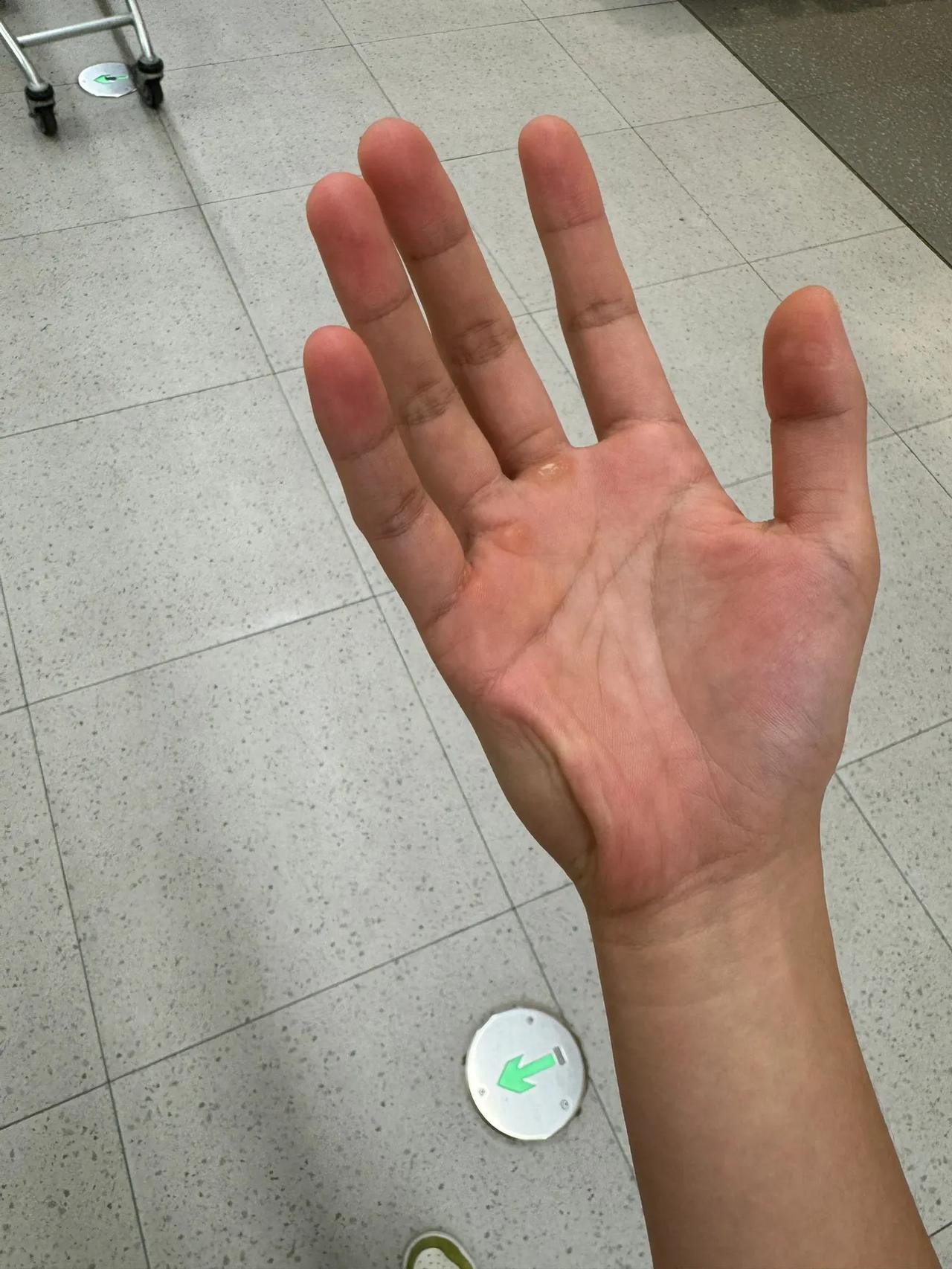 最近手老抽筋要不要紧？