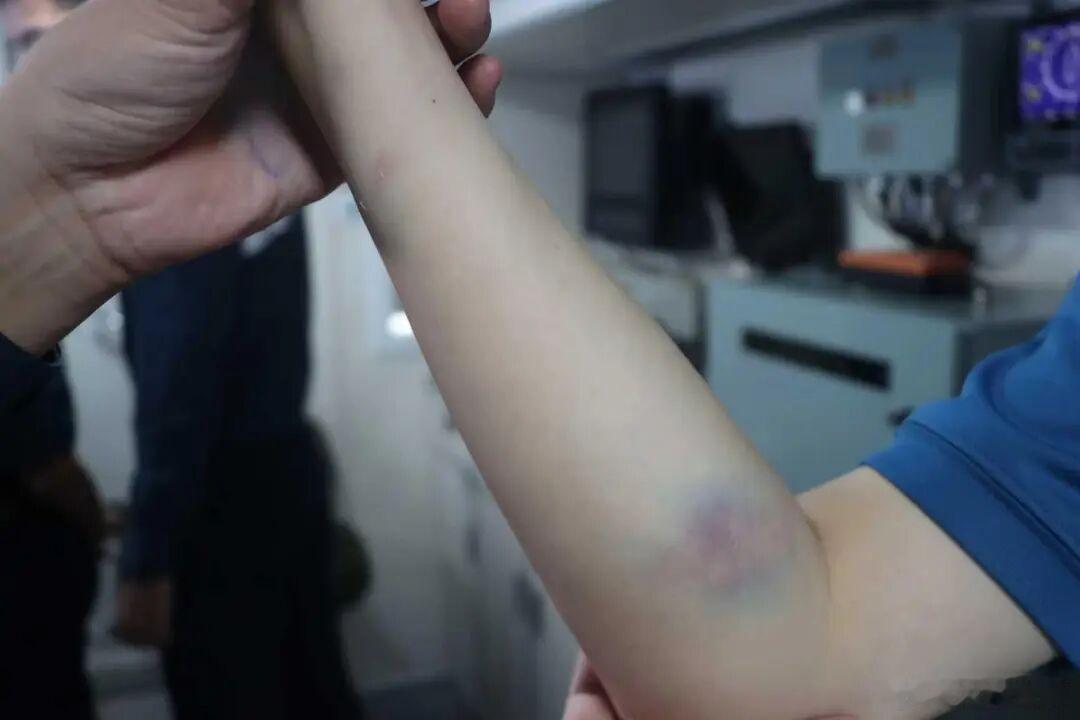 仁爱礁事件，菲方有人脑袋被开瓢，中方也有人手臂受伤。 
