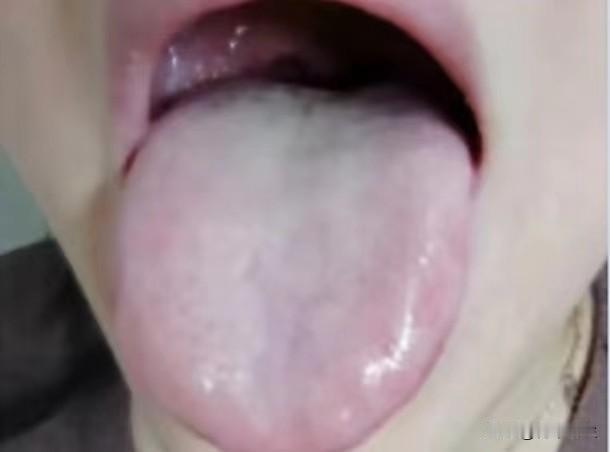 这个舌头不简单,中医教你一招解决

这个患者主诉：怕冷，爱出虚汗，尿频尿急，口干