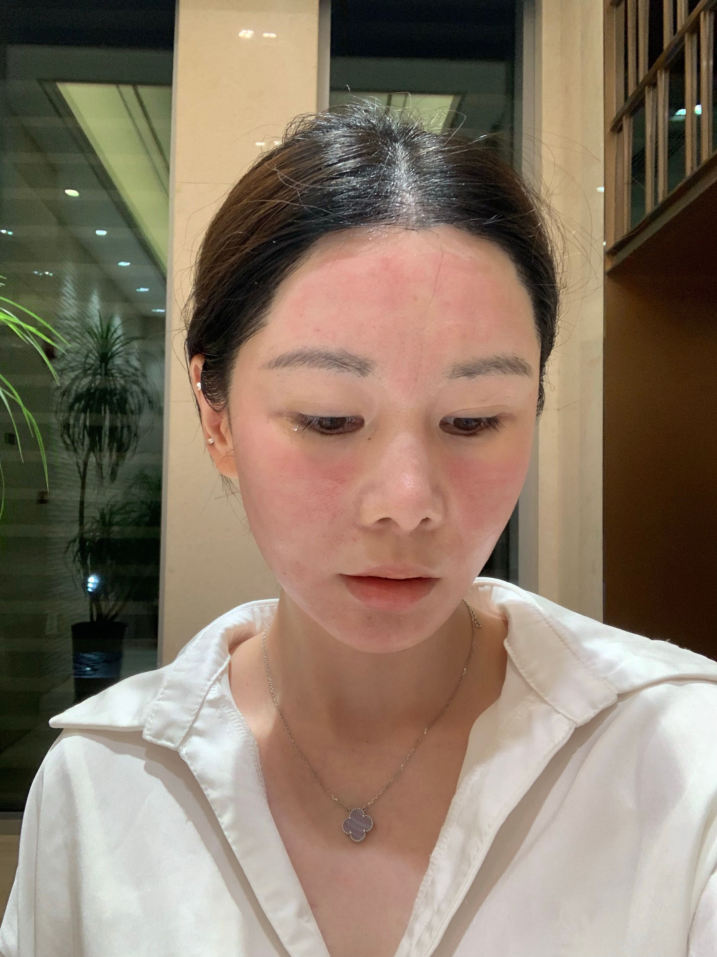 一声不吭把美迪迈打完了，官方培训的医生疼痛管理做的就是好，我这次没有打阻滞麻只是