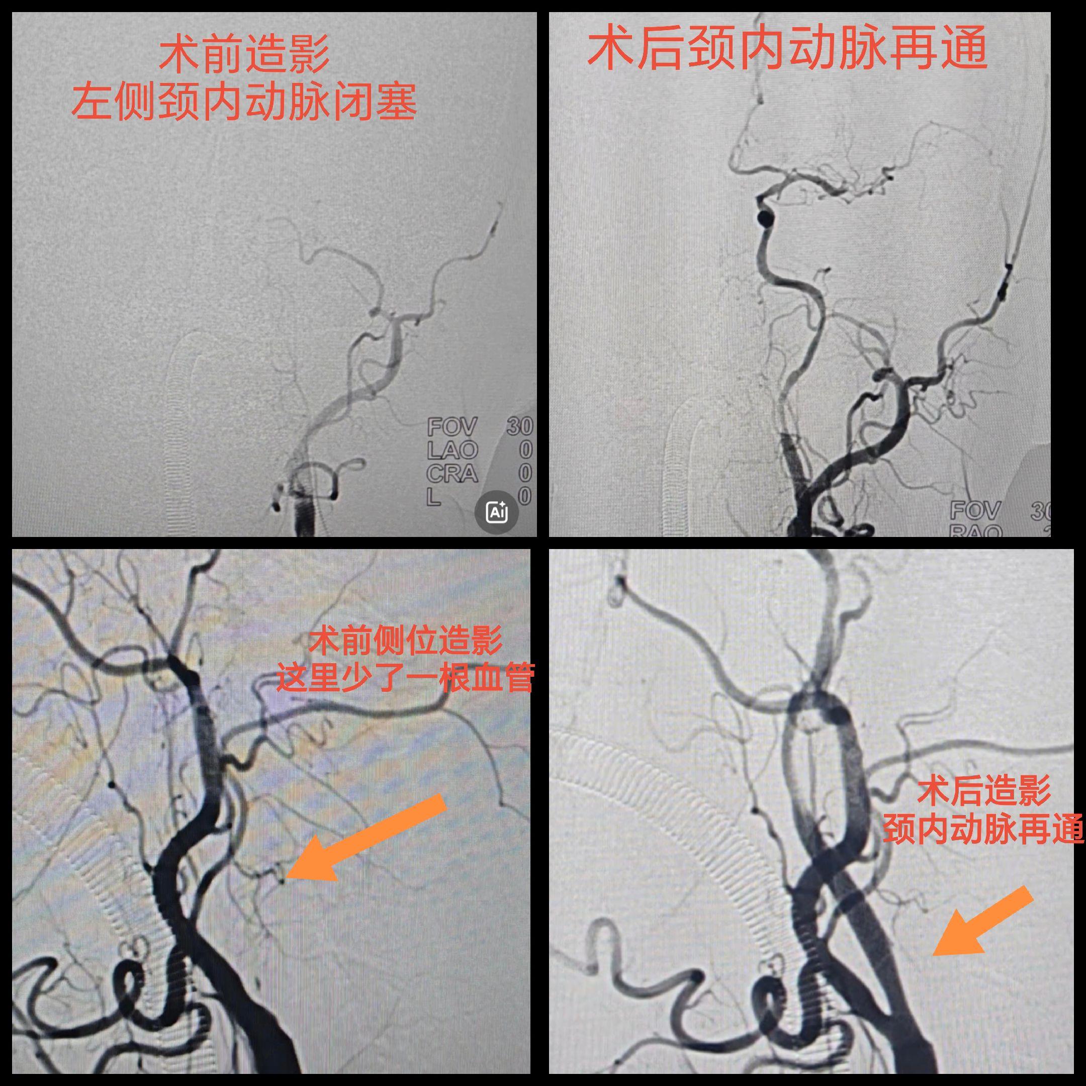 颈内动脉慢性闭塞再通，为患者打通“生命通道”。从反复梗塞的阴霾，到血流...