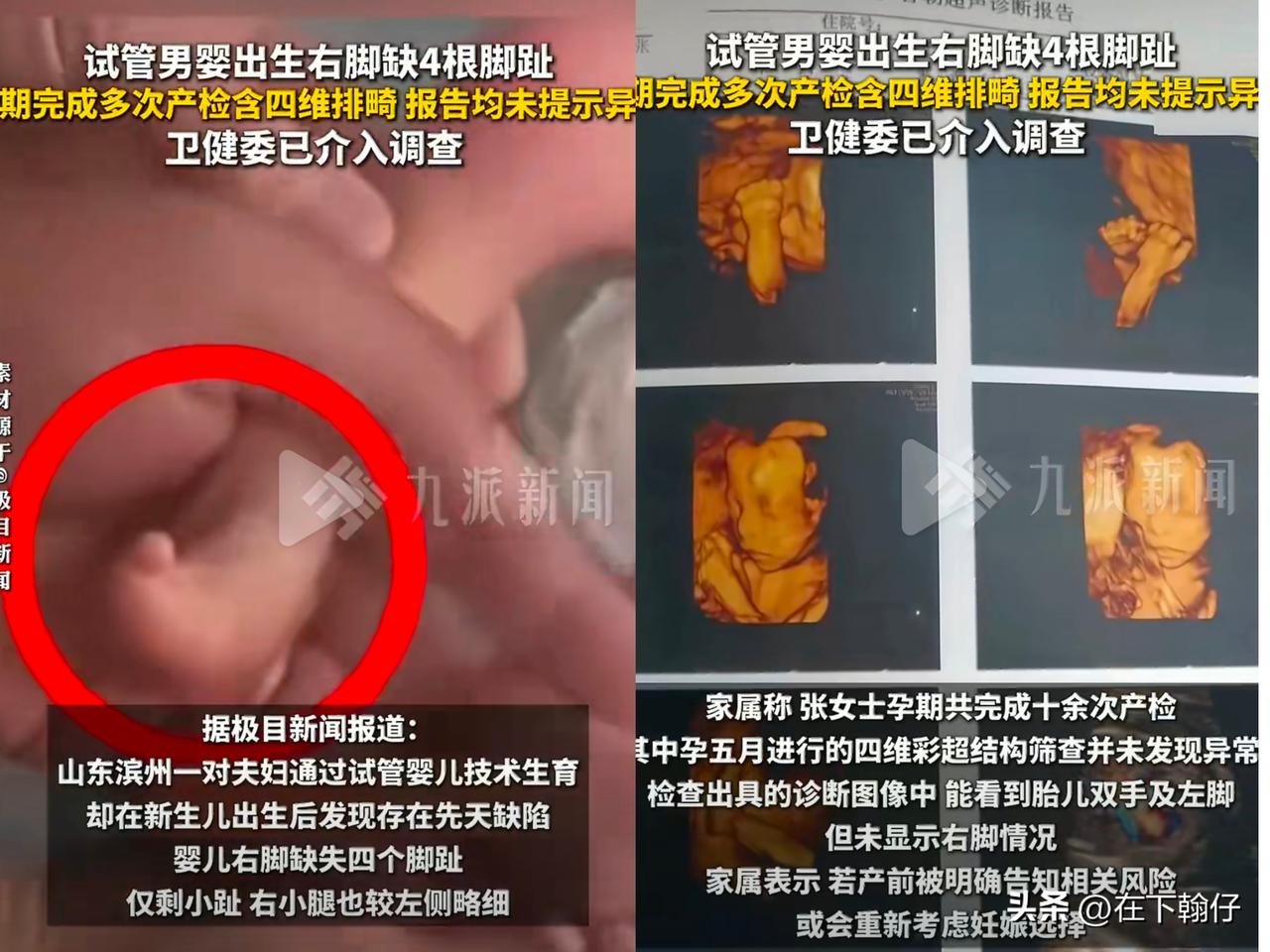 山东滨州一对夫妇通过试管婴儿技术生育，却在新生儿出生后发现存在先天缺陷。婴儿右脚