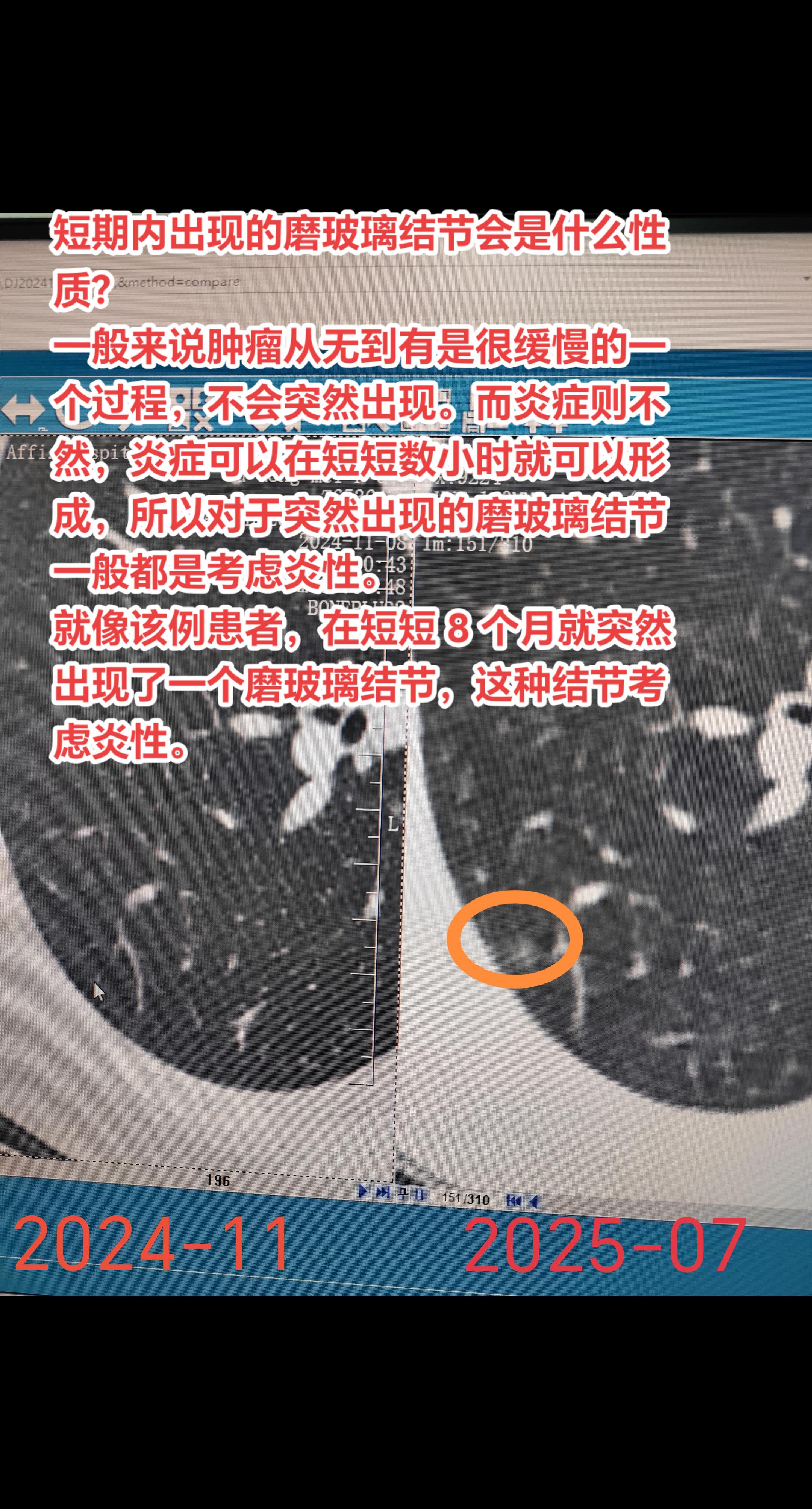 短期内出现的磨玻璃结节会是什么性质？一般来说肿瘤从无到有是很缓慢的一个...