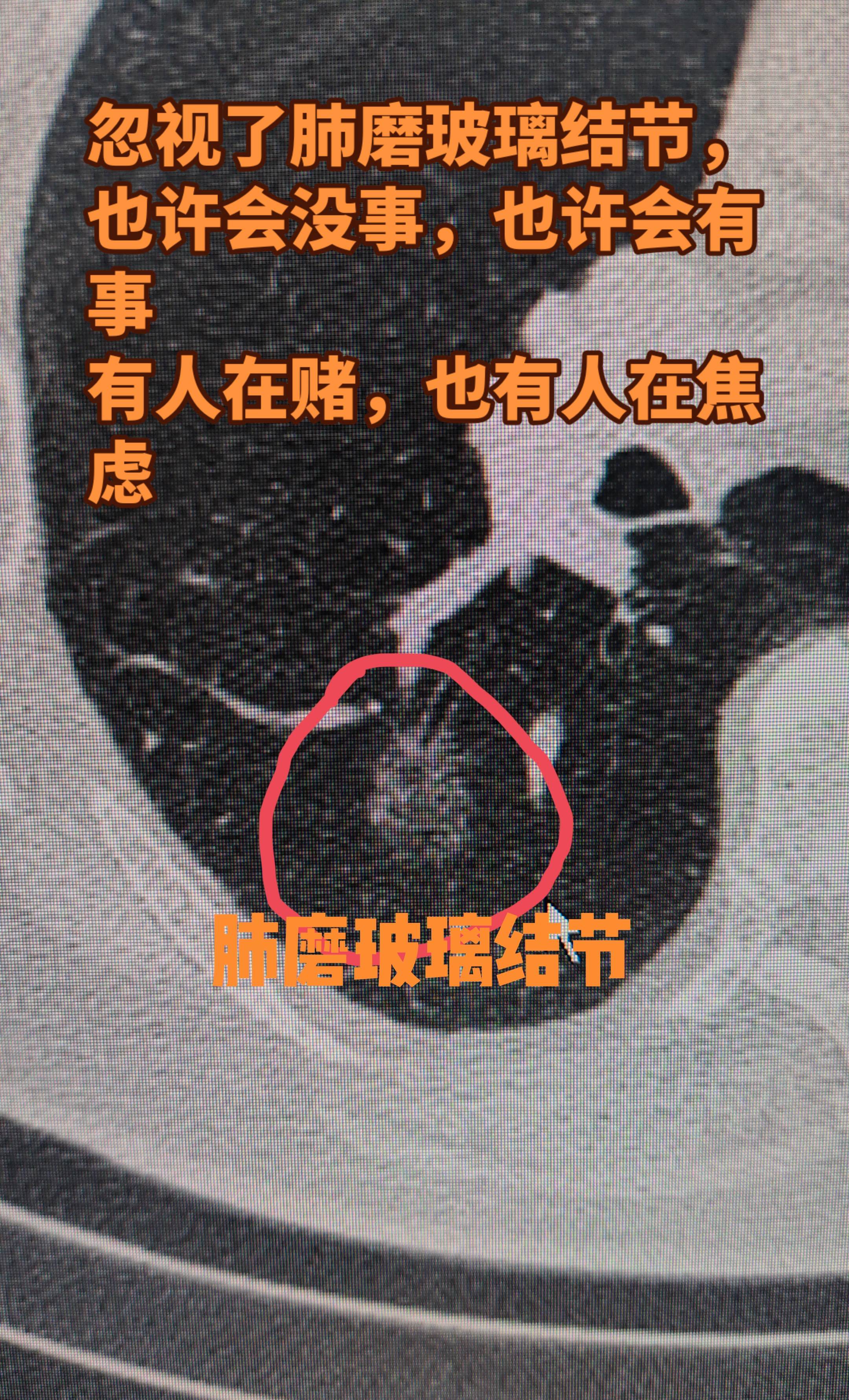 忽视了肺磨玻璃结节会怎样。体检查出肺磨玻璃结节 觉得不痛不痒、没啥症状...
