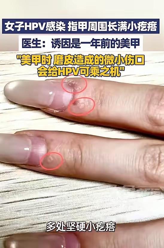 “太吓人了！”
5月9日报道，浙江杭州，一女子发现她的指甲周边，长了许多粗糙坚硬