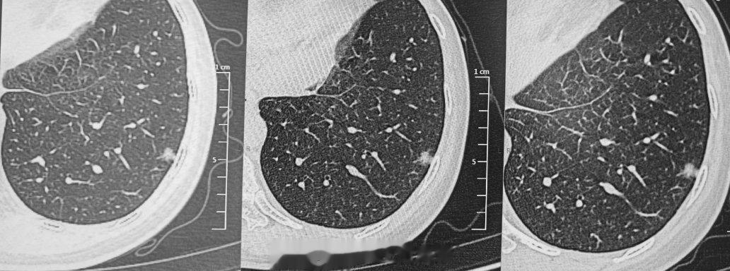 #肺结节[超话]#门诊病人好多拿着当地的CT片子来就诊。但对于小结节，打印的胶片