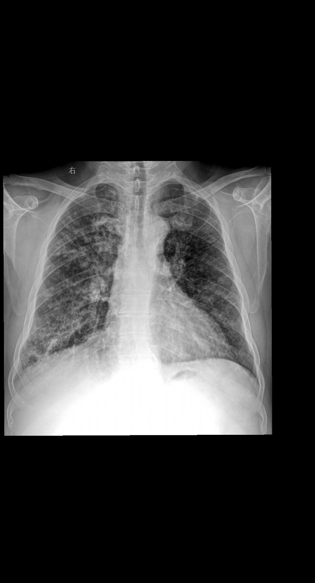 主诉:咳嗽 闷气 男 80y 考虑什么家人们？答案打到评论区