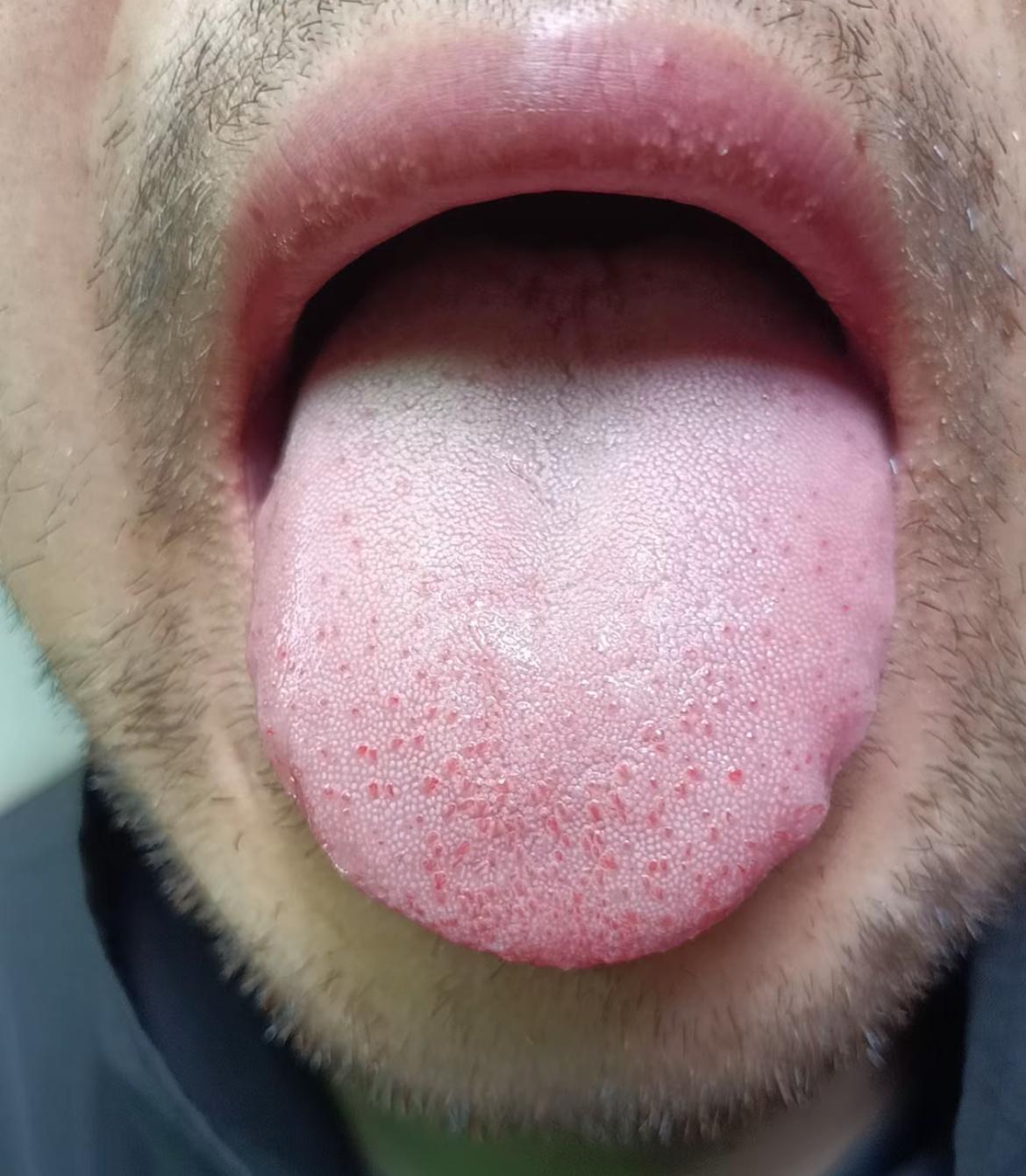 碰到这种舌象，既不能清热，也不能补阳[太阳]
舌尖有红点，舌根白淡，这是典型的心