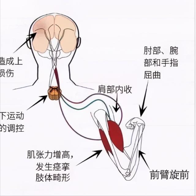 偏瘫上肢伸直困难，2个动作帮你打破屈曲痉挛
 
偏瘫之后，很多患者都有这样的困扰