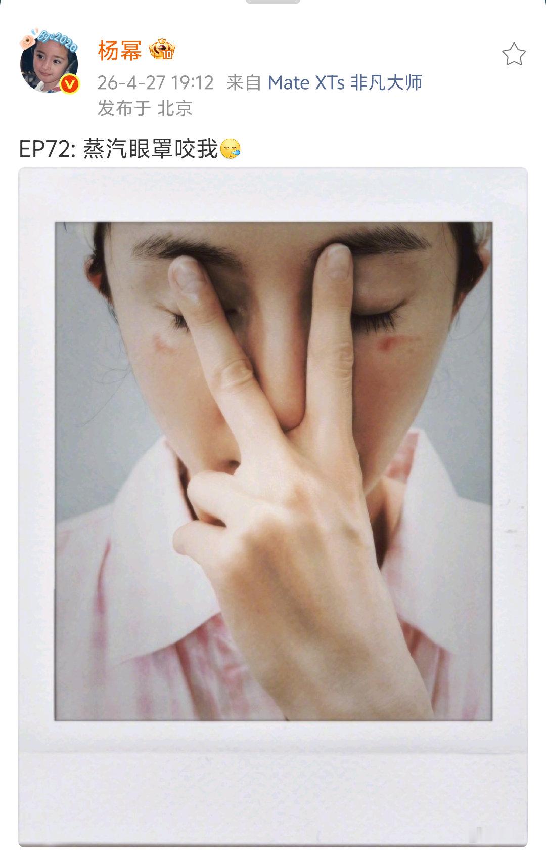 天啊杨幂的脸被蒸汽眼罩烫伤了杨幂的脸被蒸汽眼罩烫伤了杨幂被蒸汽眼罩烫伤