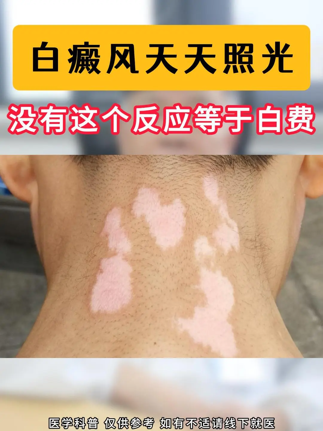 照光后白癜风出现这些现象是好的： 1、轻微红斑现象：白癜风光疗后，皮肤...