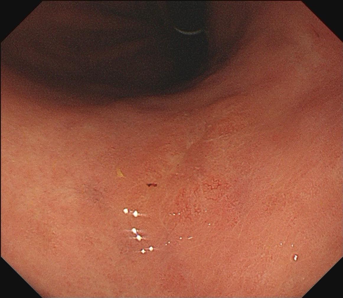 女，57岁，胃角。同事熟人，萎缩背景，色调淡黄，中央浅凹陷，腺管小而密集。