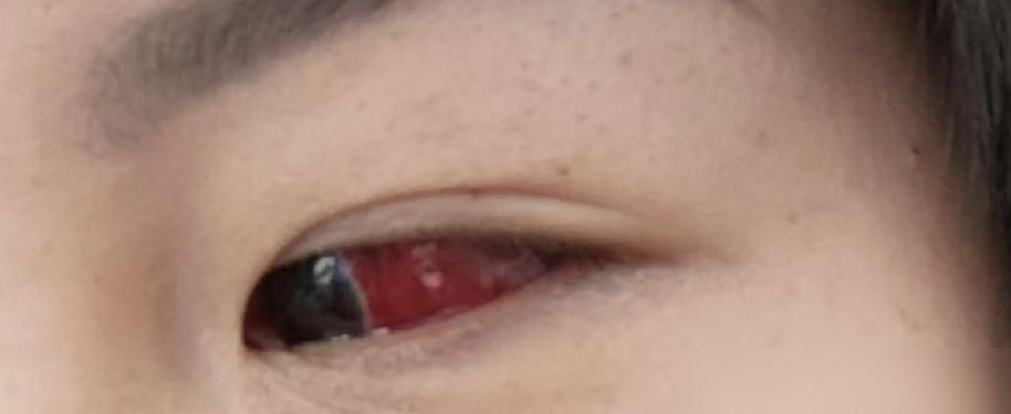 眼睛动不动就充血，差不多一年来一次，既没磕着碰着，也没使劲揉眼睛。

以前没遇到