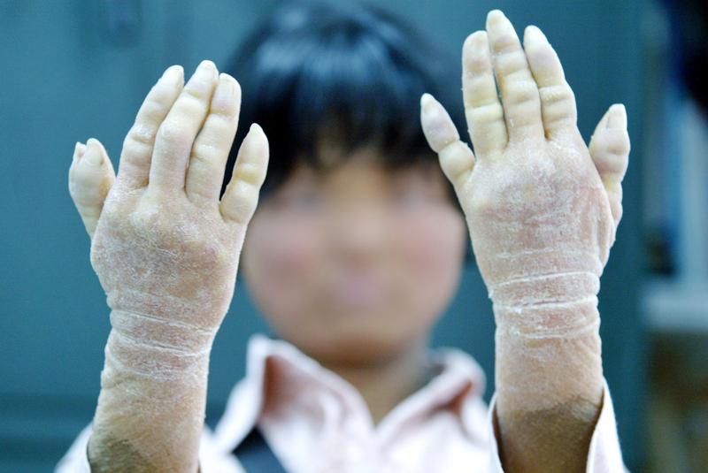 皮肤是健康“晴雨表”，它的一些变化可能是癌症信号。皮肤癌主要有鳞状细胞癌、基底细