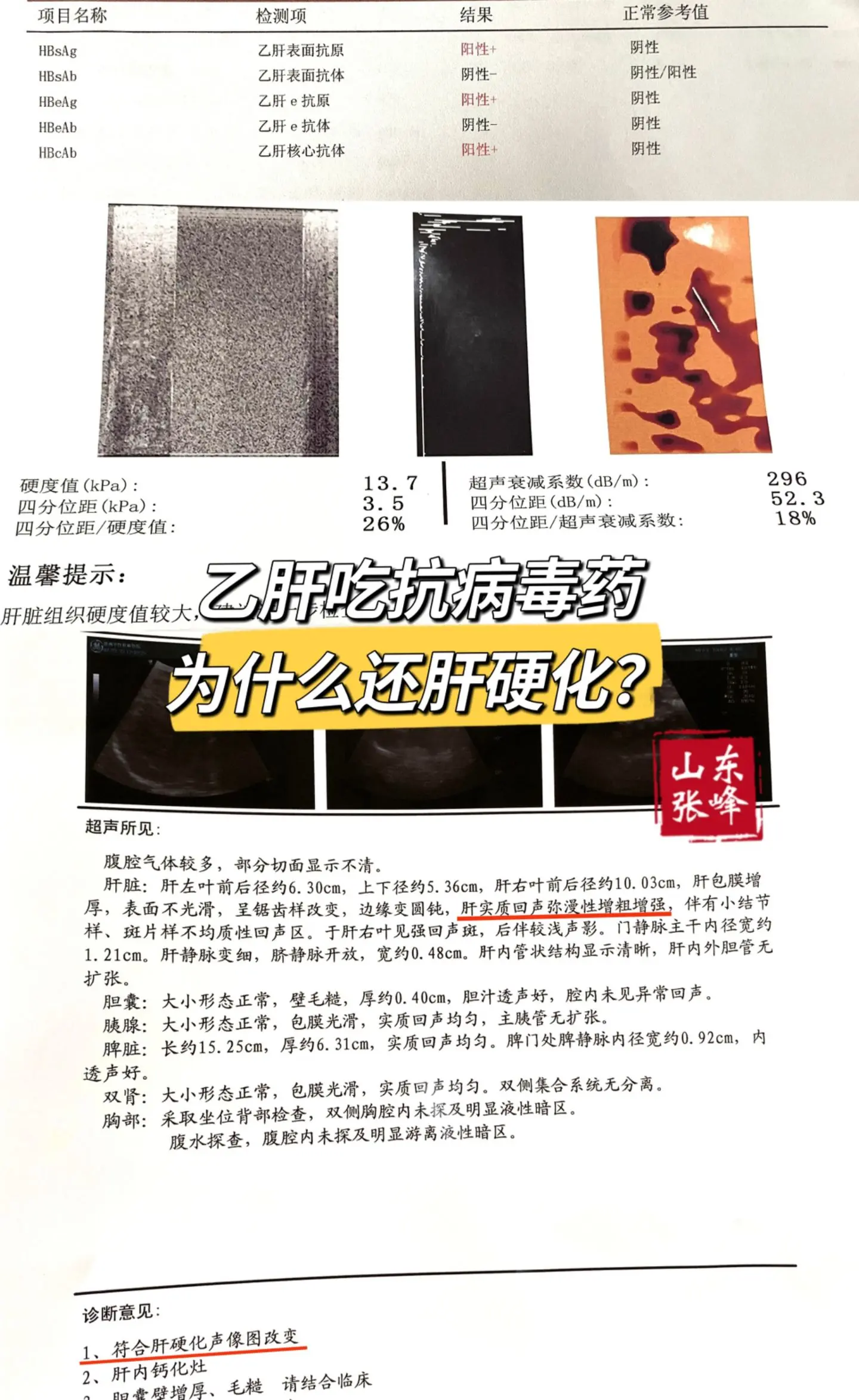 乙肝吃着抗病毒药为什么还会发展成肝硬化？ 山东枣庄患者咨询：张主任，我...