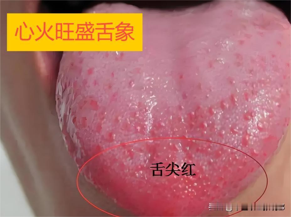 爱上火，找不到病根？中医教你看舌象、找出上火的根！

1、舌尖发红

辩证：心火