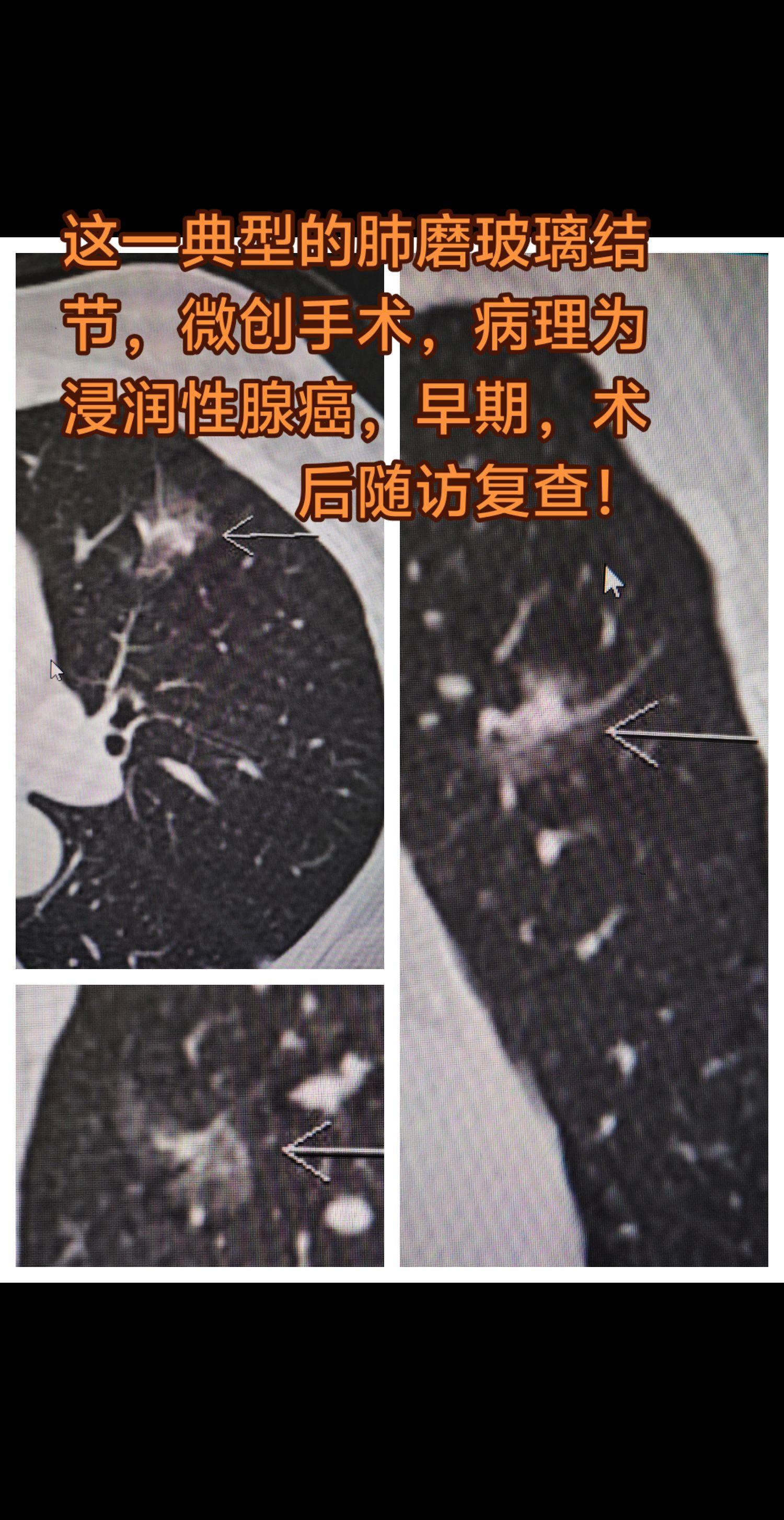 肺磨玻璃结节的手术治疗。这一典型的肺磨玻璃结节，微创手术，病理为浸润性...