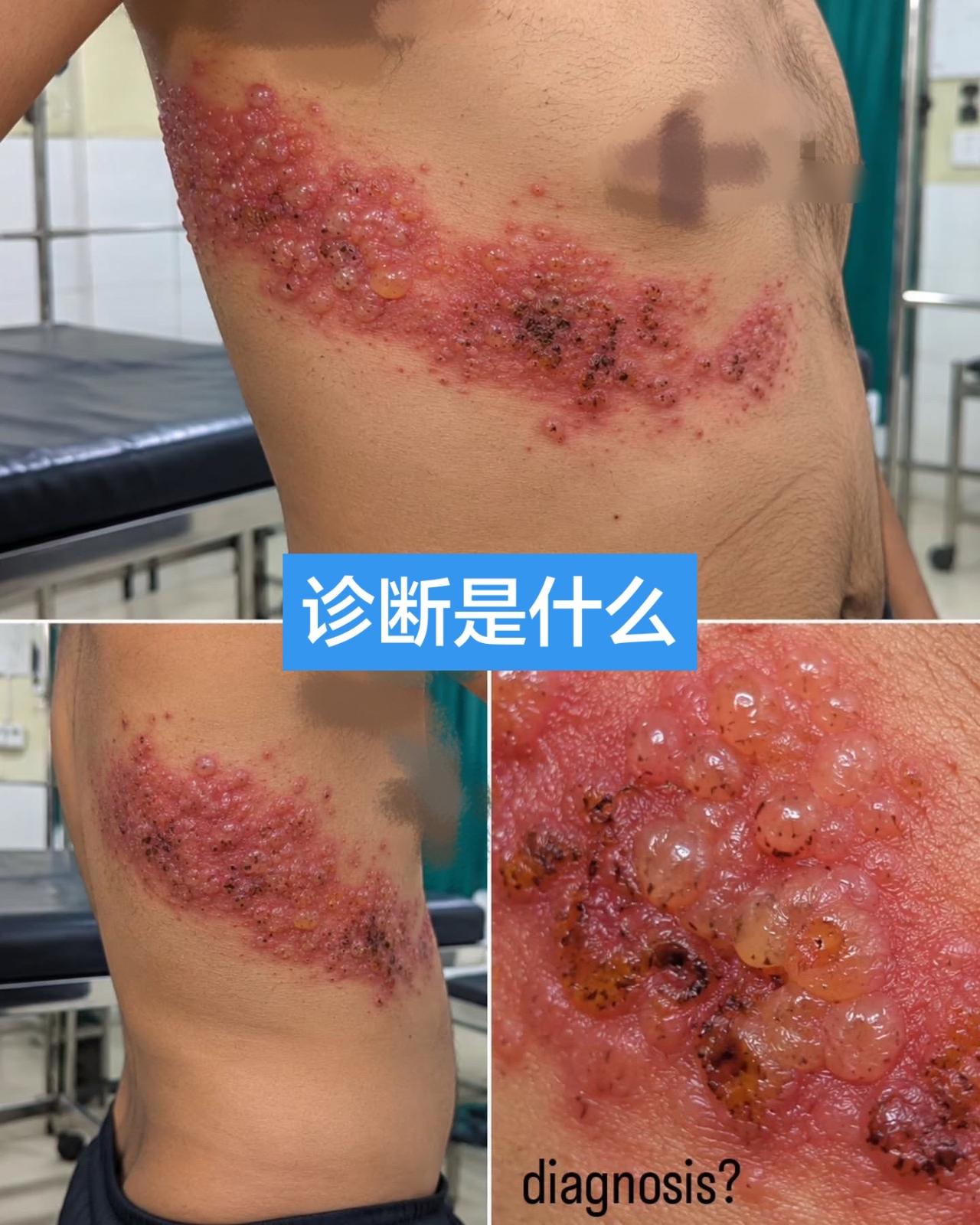 典型病变，请做出诊断！患者35岁，急性起病，剧烈烧灼痛，随后右侧胸壁及胁腹部出现