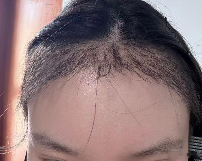 这种基础植发和额头缩小必须一起改善才大 