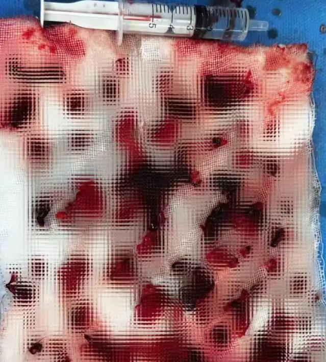 太吓人了！广东广州，一小伙只因右侧腹股沟有点疼、双腿发肿，赶到白云区人民医院一查