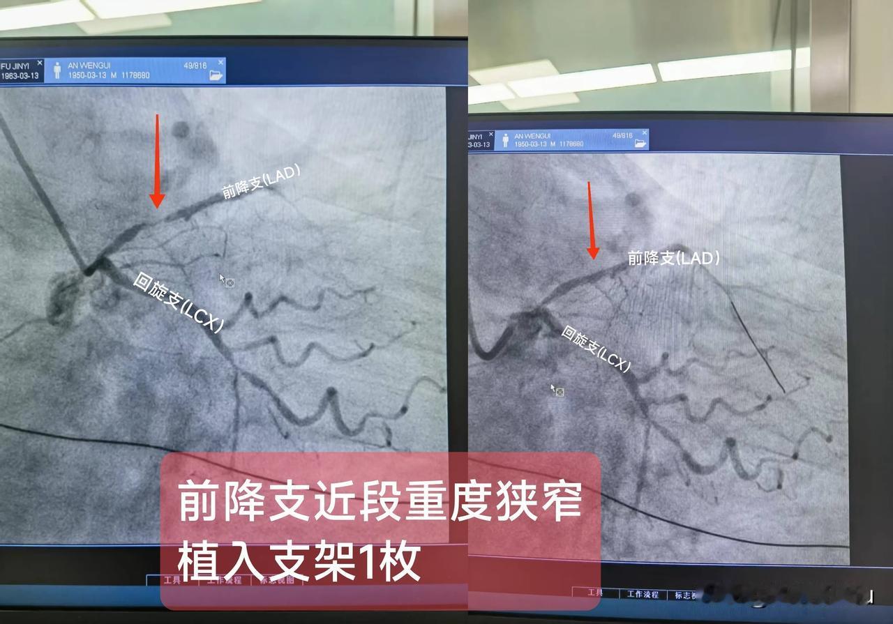 急性ST段抬高型心肌梗死
（前降支近段重度狭窄)
一.概念：
冠状动脉在主动脉根