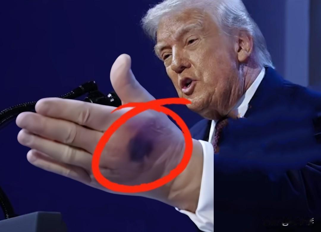 特朗普参加达沃斯论坛，手上淤青清晰可见，非常明显的那种，这让很多国家的记者都注意