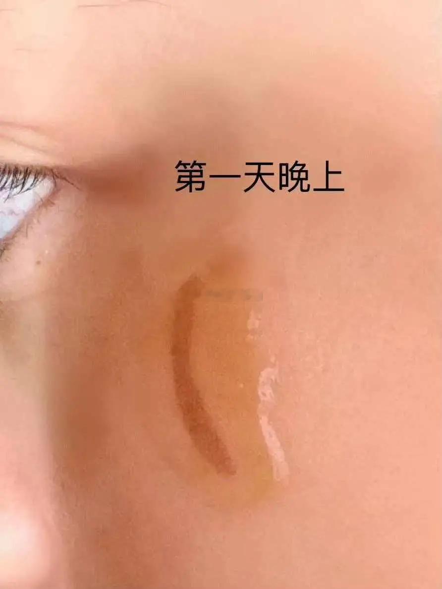 杨蓉心太大！脸部烫伤不用药不忌口，伤口吓人，直言留疤也无所谓 