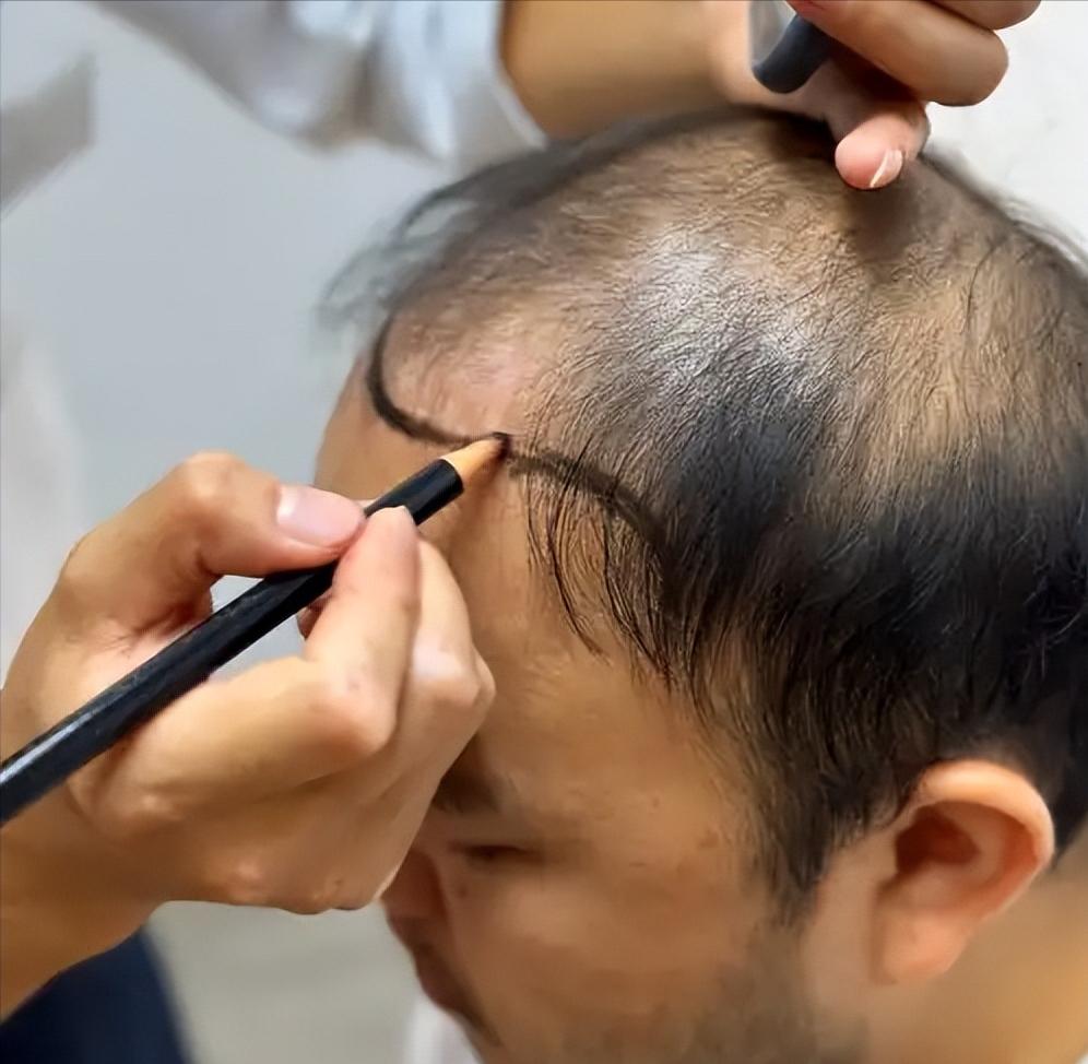 [月亮]3.4亿人深陷脱发困境，植发机构却接连闭店降温？


国内脱发人群规模已