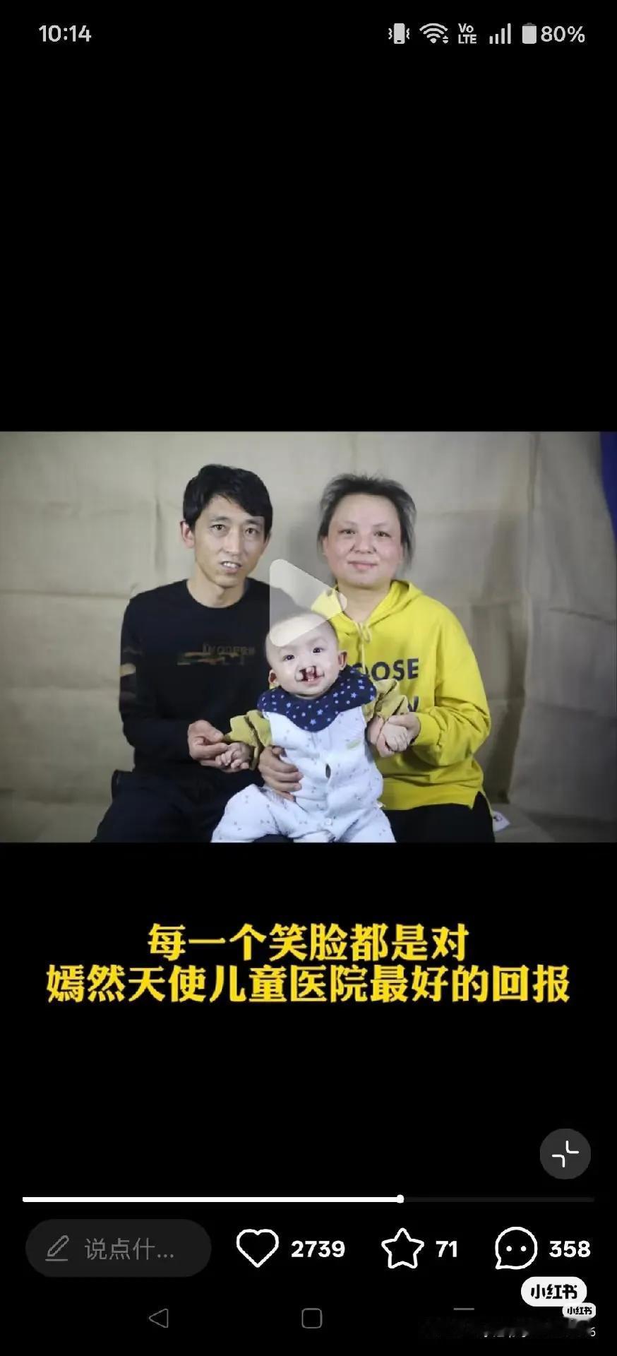 本来以为唇腭裂只是简单的兔唇，没想到还有这么严重的，看到这个孩子嘴唇的变化，真的