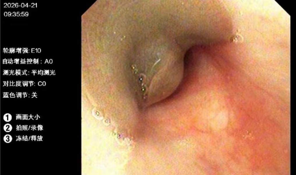 太可怕！云南临沧8岁的小林咳嗽了十几天，痰里带血，县医院抗感染治疗一点用都没有。