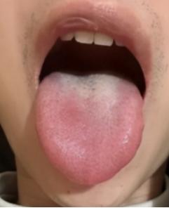 门诊接诊一位小伙子，肾都亏虚成这样了，竟还不知节制，真把自己当“牛”了
 患者主