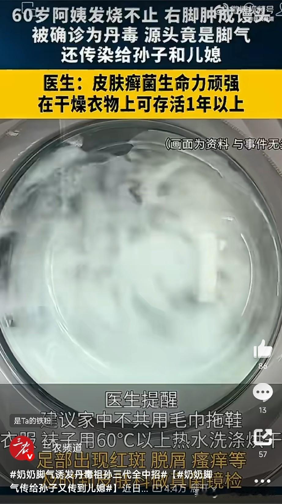 家里一人得脚气，全家人跟着遭殃

杭州一位60岁奶奶，就因为脚气没当回事，结果发