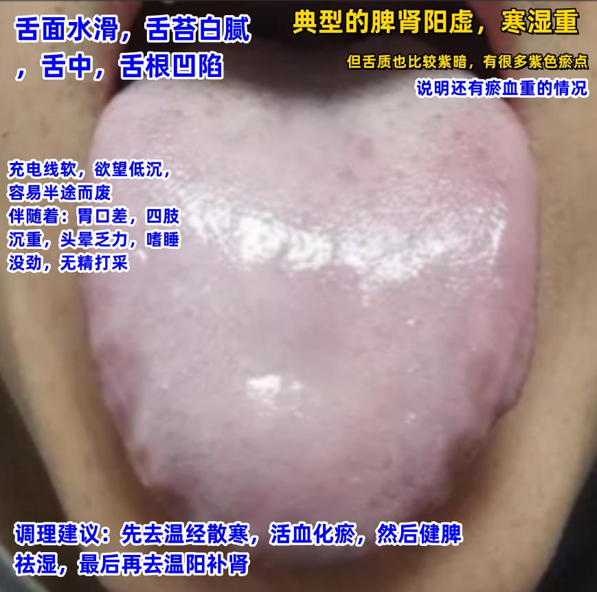 今日舌诊案例分析[给力][给力][给力]

1.舌面水滑，舌苔白腻舌中，舌根凹陷