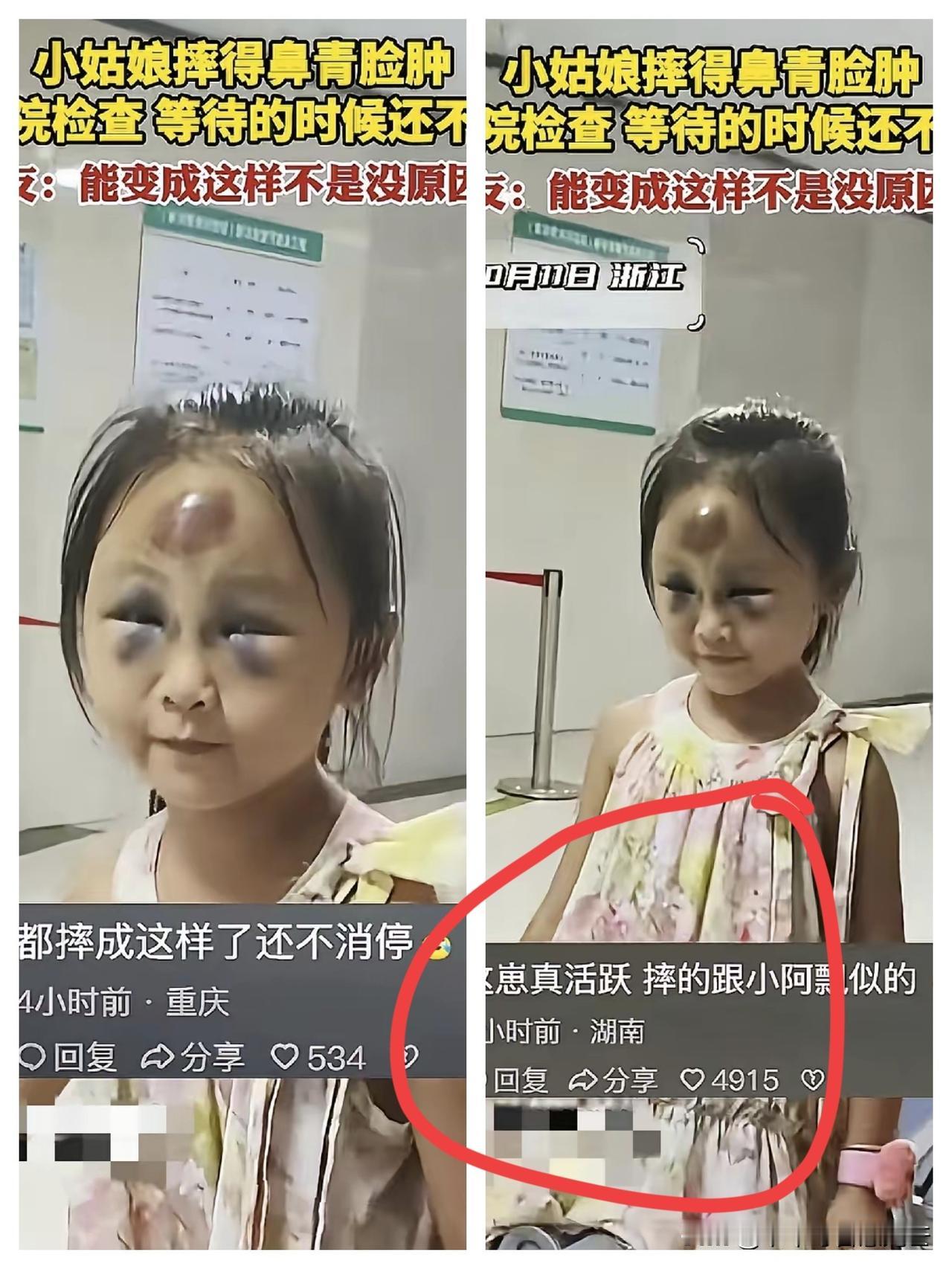 你说该心疼她还是该笑她？摔得鼻青脸肿去医院检查，结果排队等着的时候，这孩子压根坐