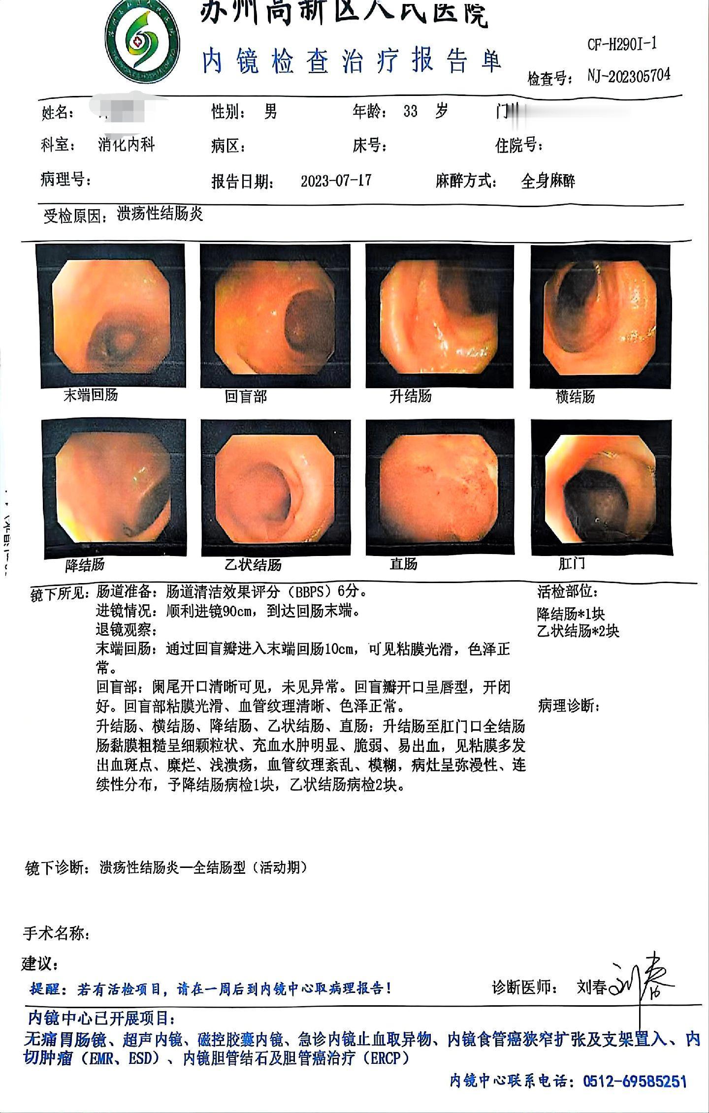 真的要警惕炎症性肠病导致的肠道肿瘤。这位患者，全结肠中重度溃结，今天复查，直肠考虑有早癌的可能。等待病理中。
在溃疡性结肠炎活动的背景下，也就是肠道溃疡，糜烂，充血水肿等问题下，很难发现异型增生。但是疾病进入到缓解期，内镜检查仔细，就会发现早癌的可能。
所以要医生要有意识，仔细去探查。病人也要有意识，定期复查，别觉得症状好了，又好了。