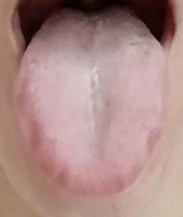 观舌辨证：脾肾阳虚引发的各类男性体虚问题调理思路







近期一位耗损精气