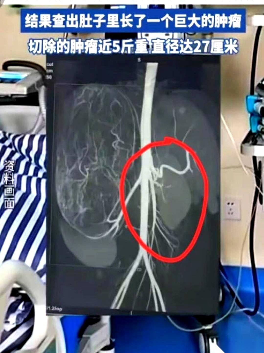 17岁的婷婷，一米六几的个子，体重只有80多斤，瘦得像根竹竿。
她就去服装店试了