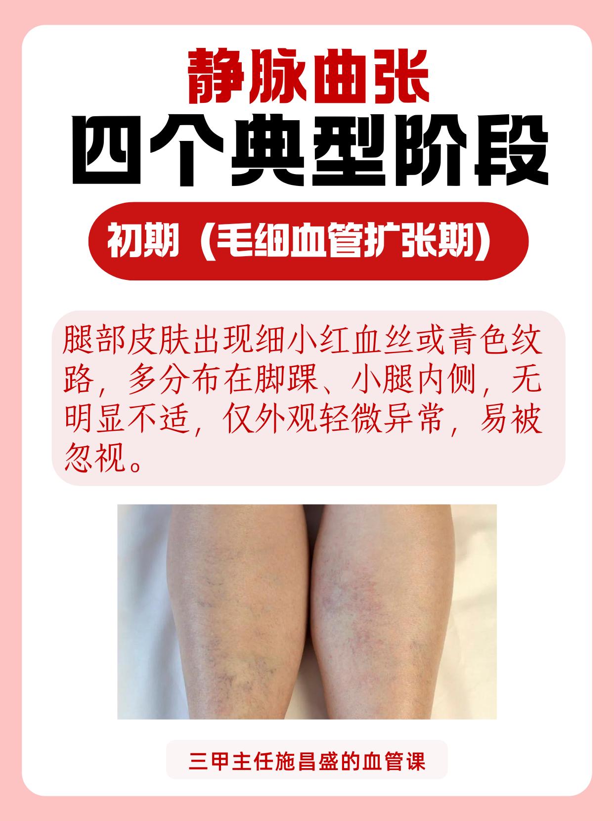 静脉曲张四个典型阶段。看看你是哪一种