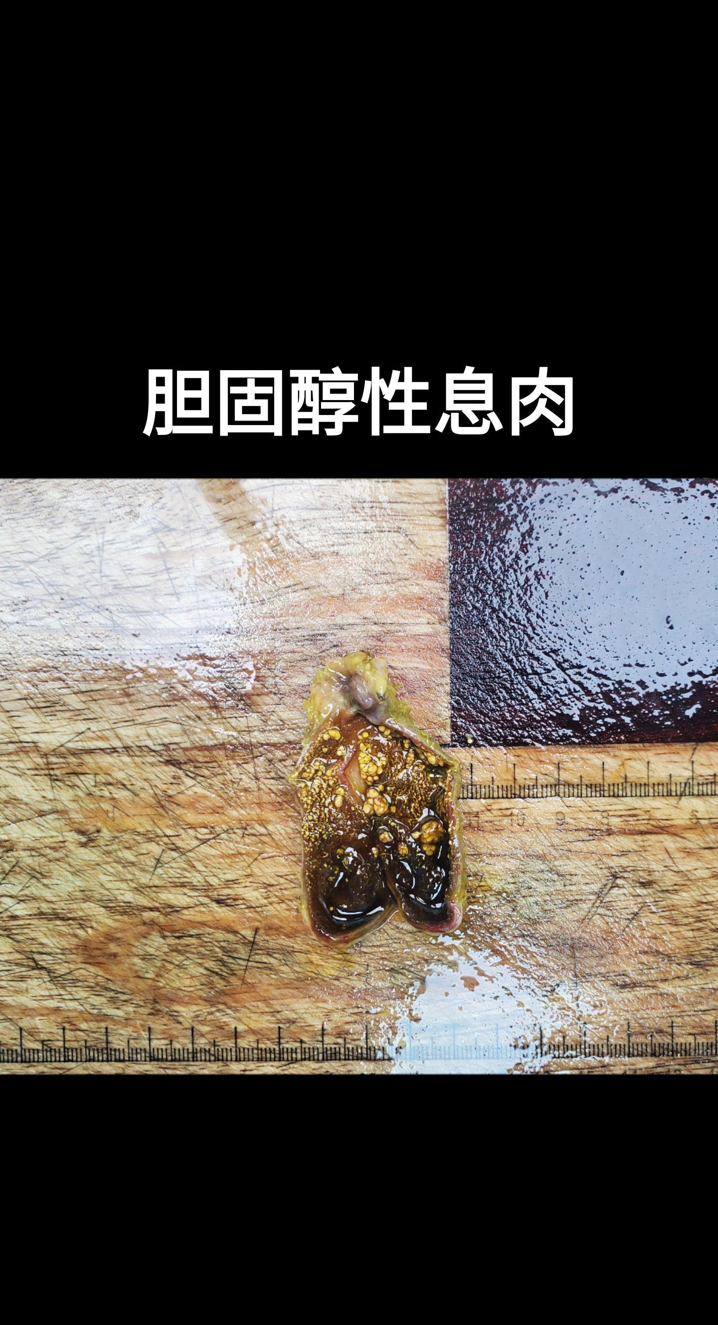 胆囊息肉