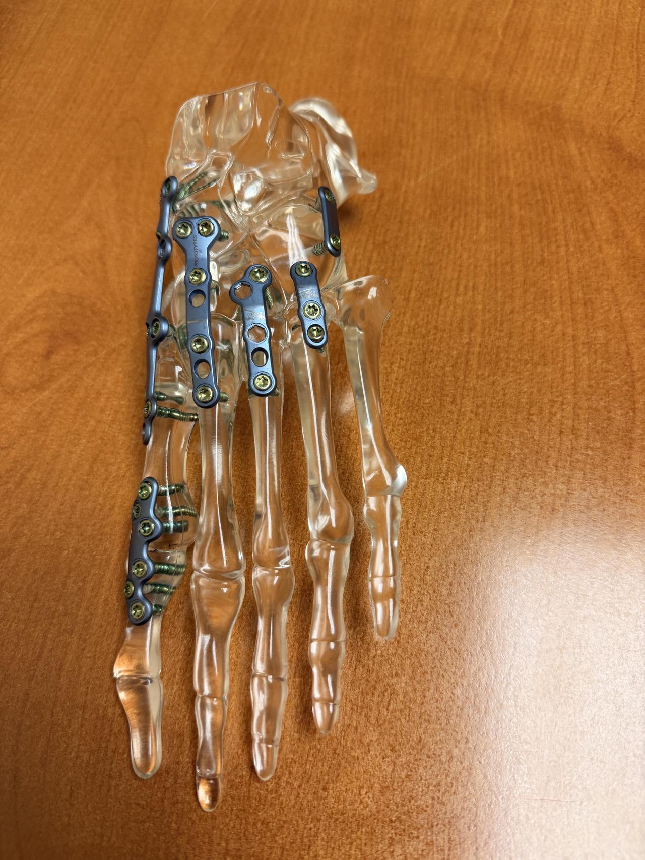 一个下周要做脚部手术的人，提前看到了将要植入自己体内的固定件模型，一排排螺丝和支