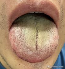 舌头能烂到这个地步，大哥你对自己也太狠了[赞][赞][赞]

主诉：尿多，一会一
