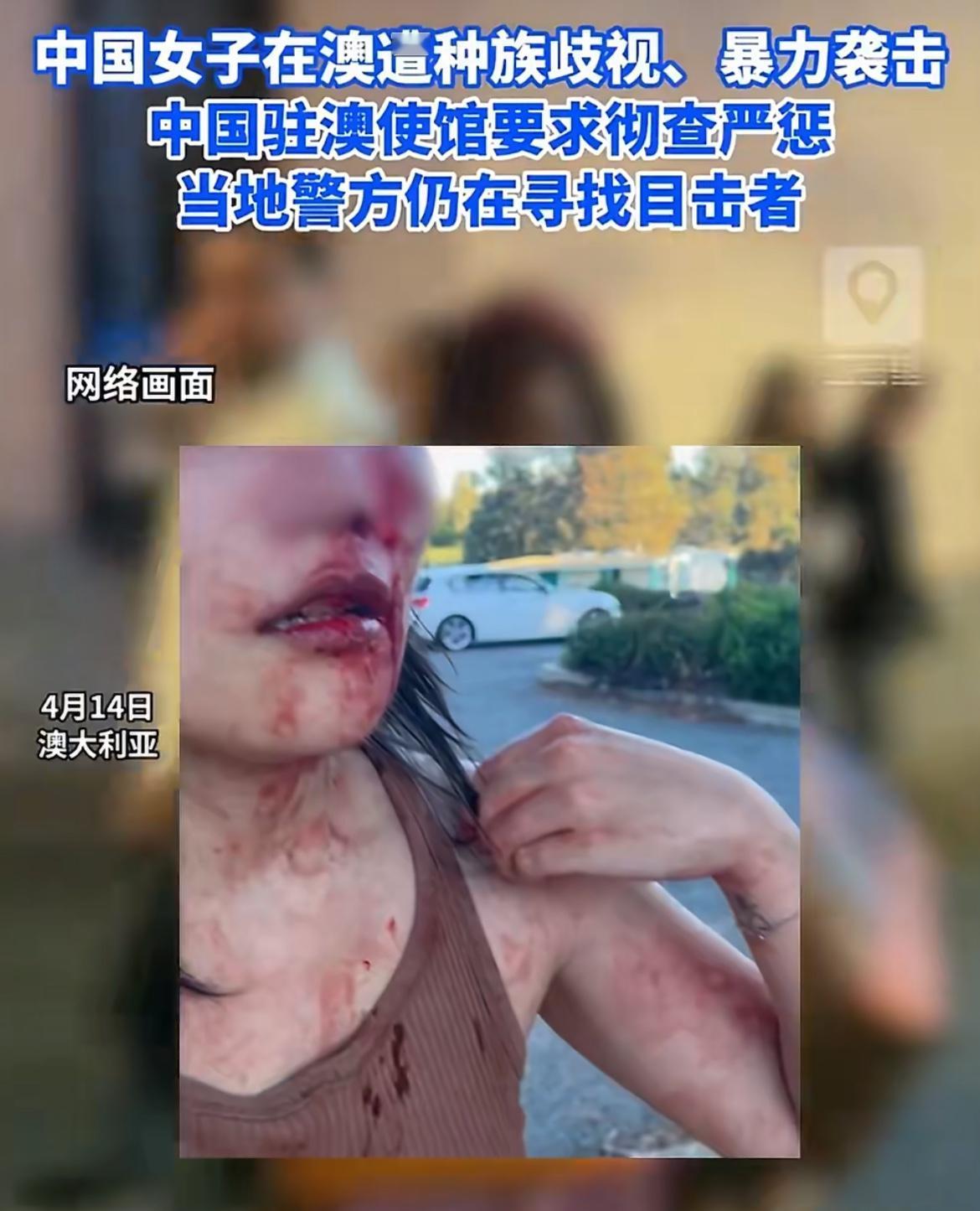 一中国年轻女子在澳大利亚街头遭遇种族歧视，被殴打致伤。4 月 2 日，一名张姓女