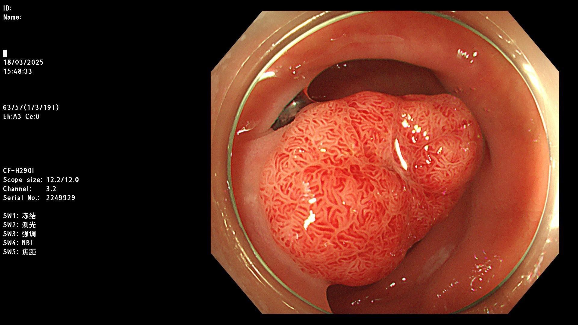 结肠腺瘤 Endocytoscopy.国产细胞内镜，能有这样的效果也不错了…