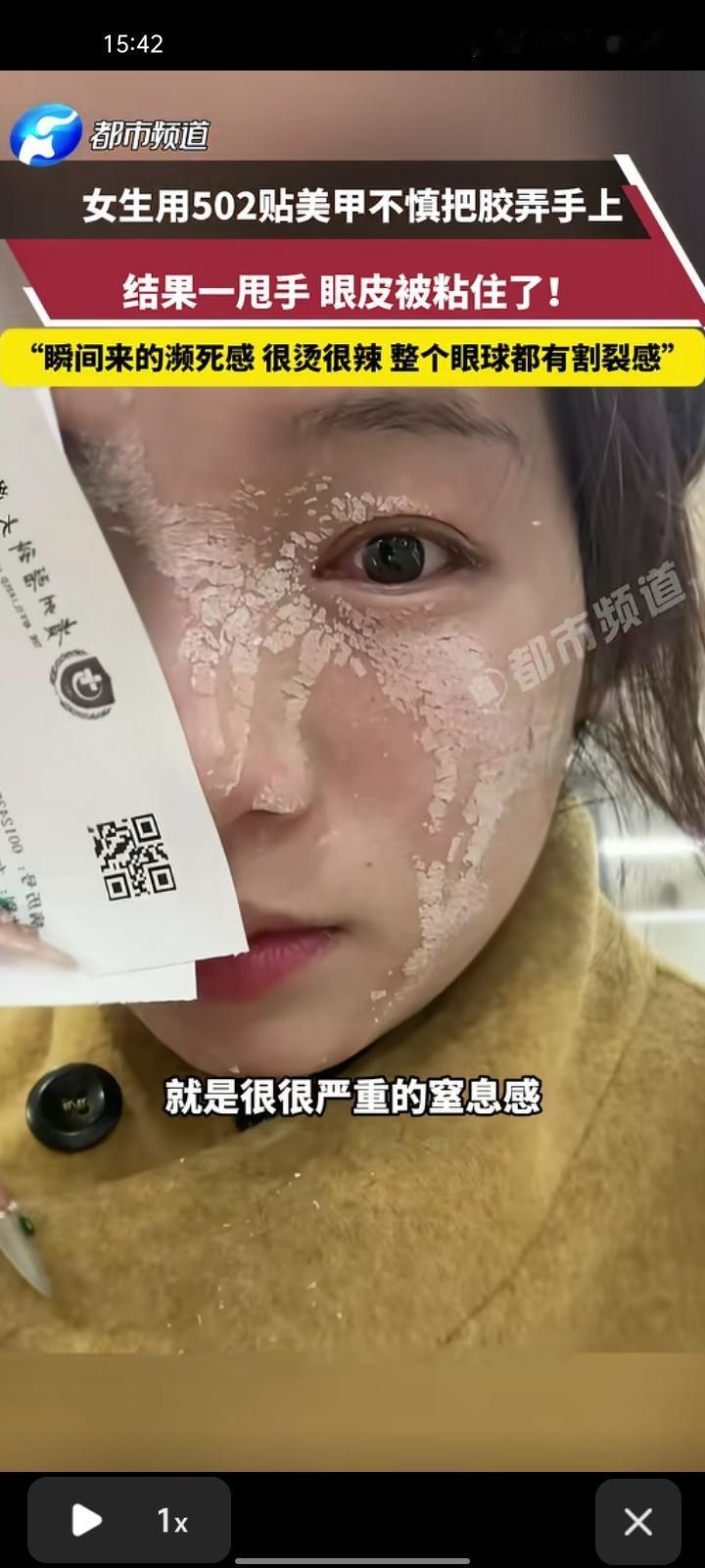 1月4日，贵州贵阳。女子用502胶水贴美甲片，不慎打翻胶水，喷溅在眼睛和鼻子上，